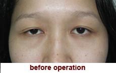 plastic-surgery-blepharoplasty